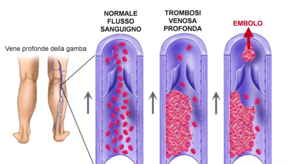La Trombosi venosa